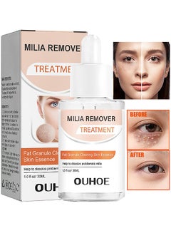OUHOE Milia Removal Treatment, Milia Spot Treatment Helps Dissolve And