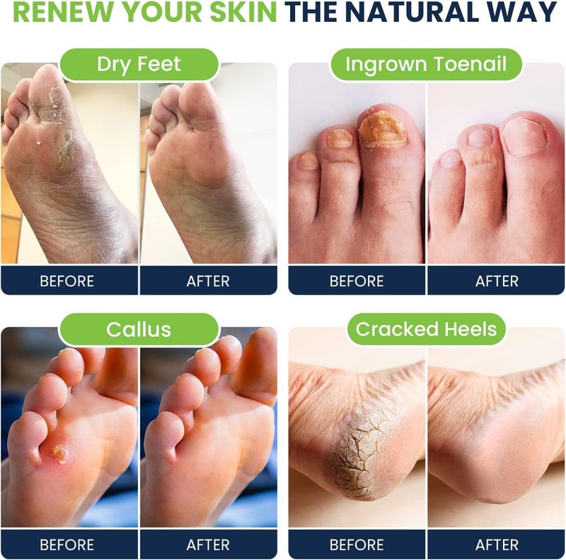 FOOT CURE Tea Tree & Citrus Foot Soak with Epsom Salt â€“ Supports Tired Feet, Softens Calluses, and Refreshes (Pack of 2) - Image 2