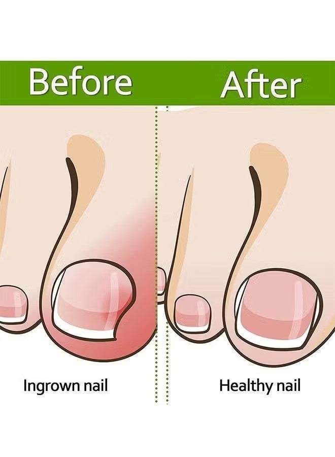 Ingrown Toenail Corrector Strips Toenail Correction Patches Curved Toenails Straightening Recover Clips Thick Paronychia Pedicure Tool Toenail Straightener Strip for Men Women Foot Care 100 Pieces - Image 3