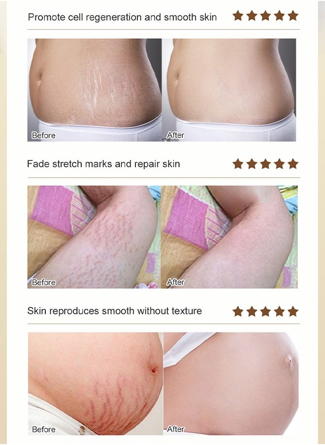 Rose Stretchmarks Cream 40g,  Contains Rose Essence, Can Promote Cell Regeneration, Repair Necrotic Cells and Enhance Skin Elasticity, Designed For Mother's Stretch Marks