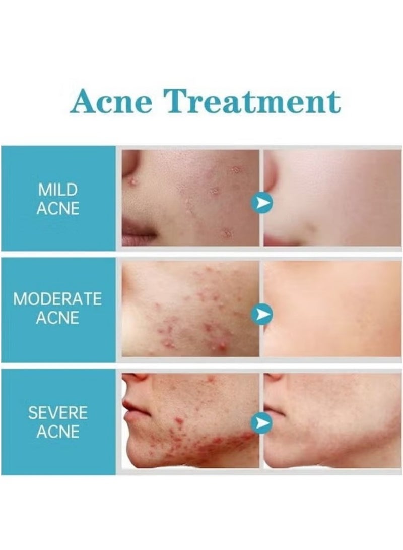 AuQuest Salicylic Acid Acne Treatment Cream – 15ml Whitening & Blackhead Removal Face Cream with Hyaluronic Acid | Skin Repair & Brightening Essence - Image 3