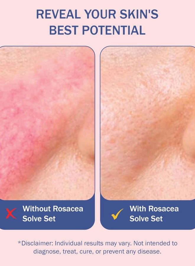 E70 Rosacea Solve Set - Includes Rosacea Cream, Serum and Moisturizing Face Wash - Combined Beneficial Ingredients such as Aloe Vera, Hyaluronic Acid, Niacinamide Coconut Oil, Cucumber, Wheat, Fruit - Image 5