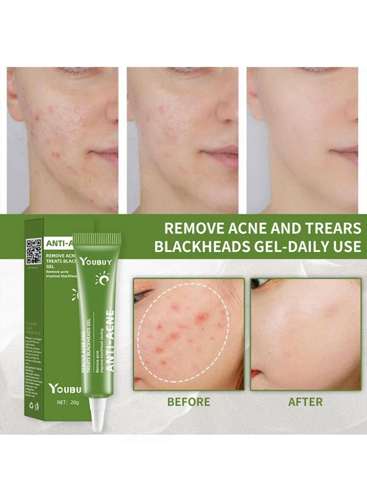 YOUBUY Anti-Acne Remove Acne and Treats Blackheads Gel-Day Use Remove Acne Pimple and Treats Blackhead with Azelaic Acid Oil Control Shrink Pores Redness Relief Skin Lightening Scar Fade Cream Acne Remover Cream 20g - Image 2