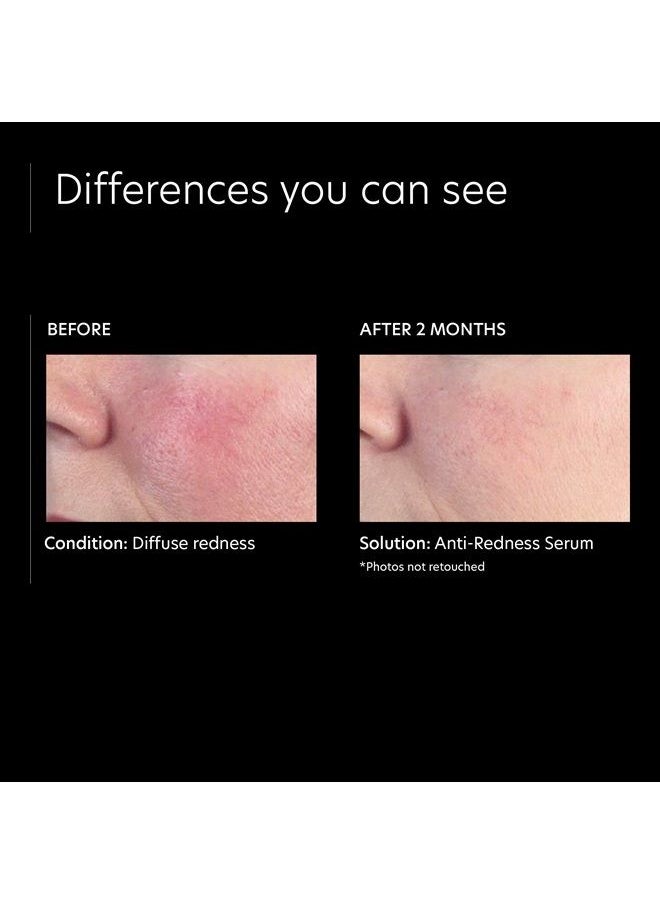 PCA SKIN Anti Redness Remover Face Serum - Oil-Free Treatment Formulated with Advanced Calming Ingredients, Improves Irritation & Skin Tone (1 fl oz)  - Image 4