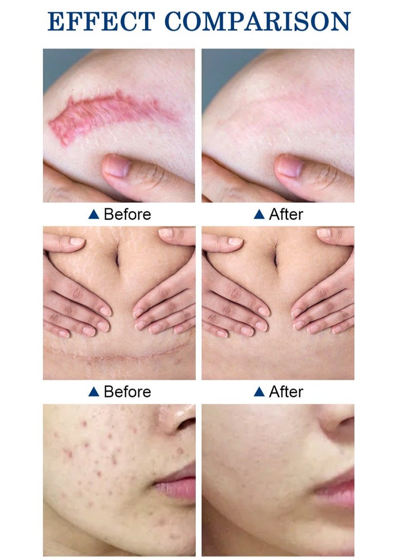 MOOYAM Scar Removal Cream Skin Treatment for Scars Stretch Marks and Acne Marks Improves Skin Texture with Deep Moisturization for All Skin Types - Image 4