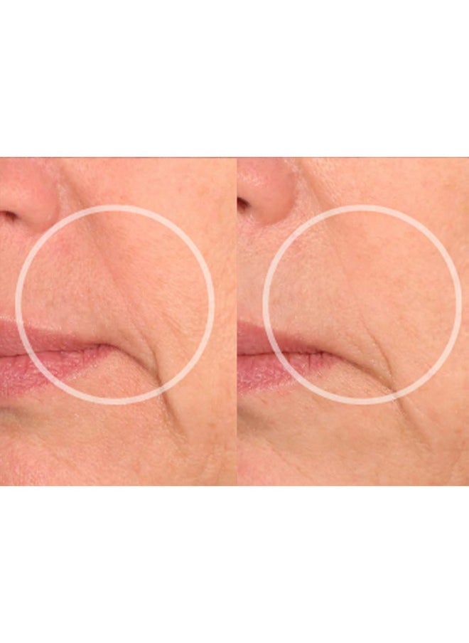 Sio - Beauty Eye And Smile Lift Antiwrinkle Patches 4 Week Supply Overnight Under Eye Mask Pads For Dark Circles Silicone Skin Treatment For Wrinkles - Image 1