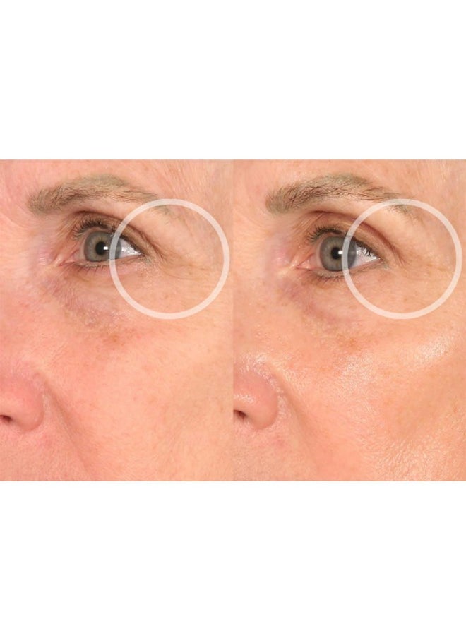 Sio - Beauty Eye And Smile Lift Antiwrinkle Patches 4 Week Supply Overnight Under Eye Mask Pads For Dark Circles Silicone Skin Treatment For Wrinkles - Image 1