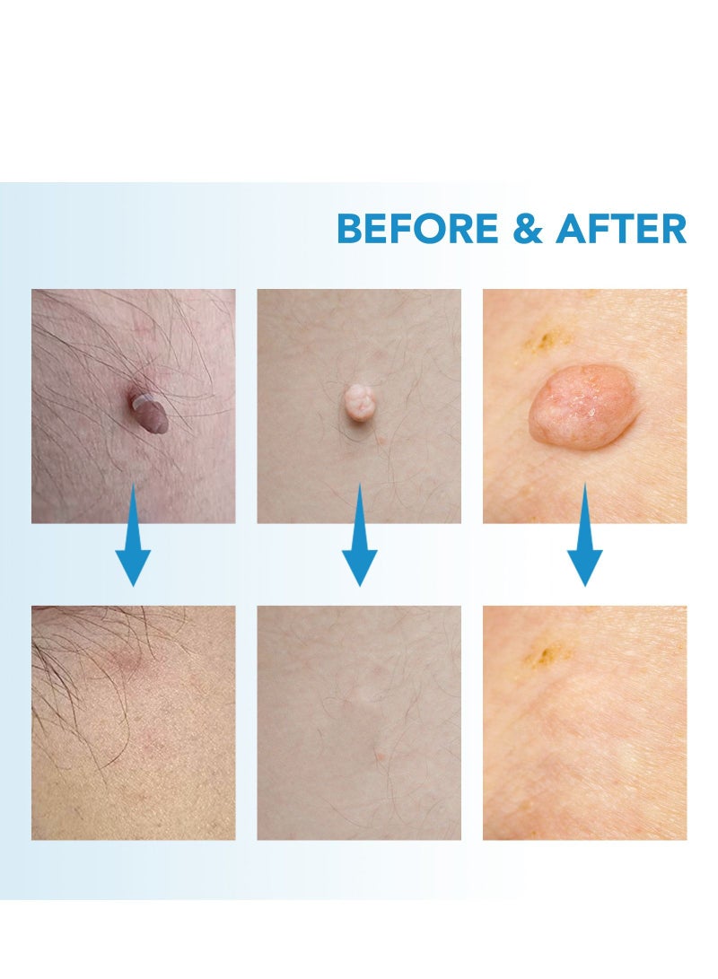 سيفودون أداة إزالة الثؤلول إزالة علامات الجلد ذات الرأس المزدوج باللون أزرق - Image 4