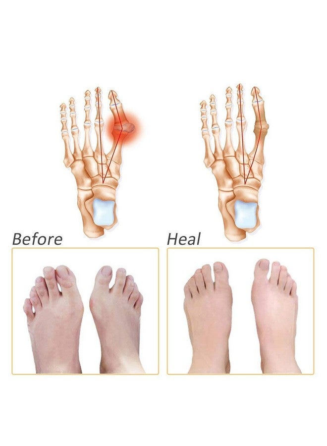 Wryer Silicone Gel Half Toe Sleeve Pads Tapkaa Antiskid Forefoot Soft Pads For Pain Relief - Image 2