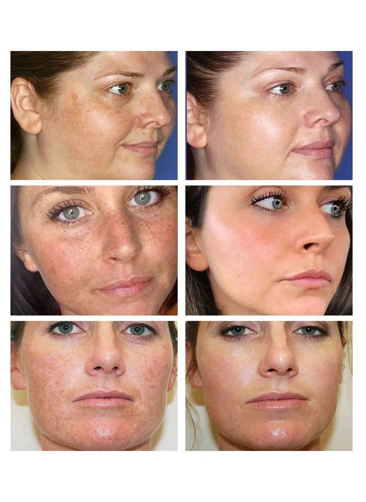 iBealee - Dark Spot Remove for Face Peeling Skin Whitening Freckle Cream Pigmentation Treatment Sun Spots Blemish Remover Lightening Cream - Image 1