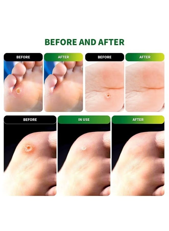 Sumifun 54 Pcs Corn Remover Pads, Foot Care Treatment for Corns & Calluses, Foot Corn Removal Plaster, Relief Pain From Calluses, Corns, Blisters, Heel Rubbing  - Image 2