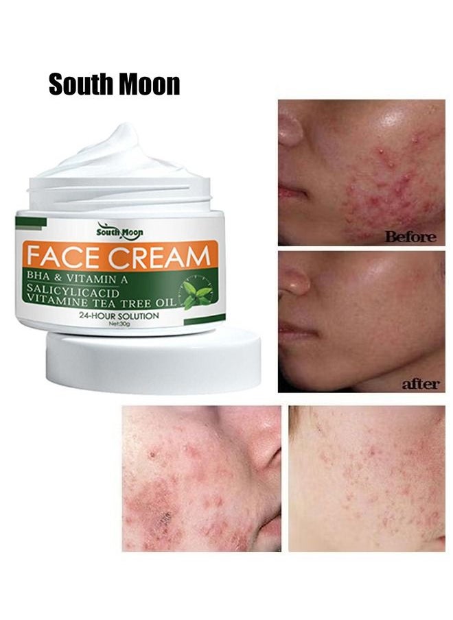 SOUTH MOON - Acne Treatment Face Cream, Acne Spot Treatment for Face & Acne Dots, Natural Cystic Acne Treatment, For All Skin Types, Premium Acne Scar Cream & Pimple Remover - 30ML - Image 1