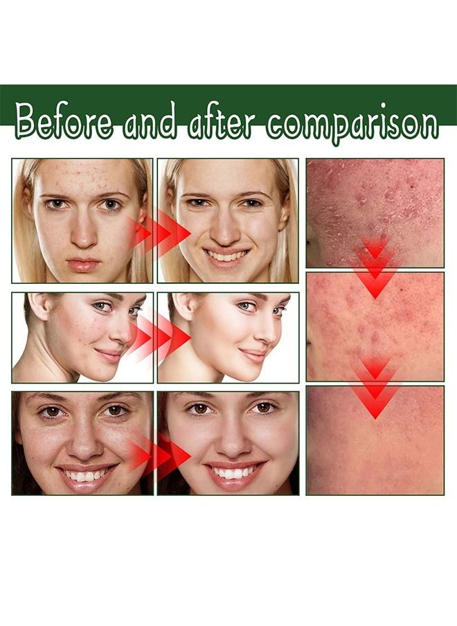 SOUTH MOON - Acne Treatment Face Cream, Acne Spot Treatment for Face & Acne Dots, Natural Cystic Acne Treatment, For All Skin Types, Premium Acne Scar Cream & Pimple Remover - 30ML - Image 1