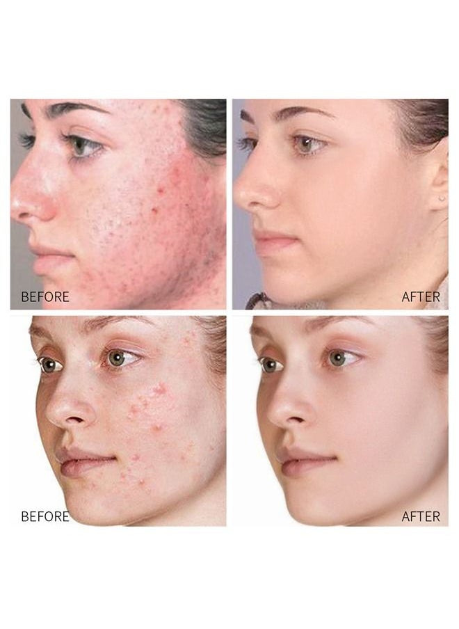 SOUTH MOON - Acne Treatment Face Cream, Acne Spot Treatment for Face & Acne Dots, Natural Cystic Acne Treatment, For All Skin Types, Premium Acne Scar Cream & Pimple Remover - 30ML - Image 1