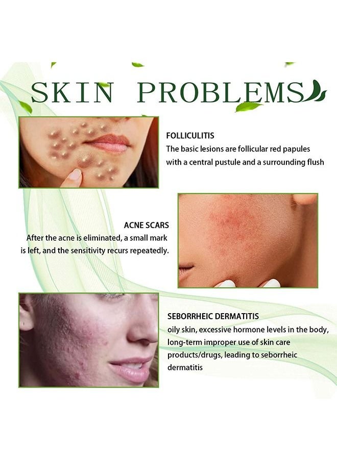 SOUTH MOON - Acne Treatment Face Cream, Acne Spot Treatment for Face & Acne Dots, Natural Cystic Acne Treatment, For All Skin Types, Premium Acne Scar Cream & Pimple Remover - 30ML - Image 1