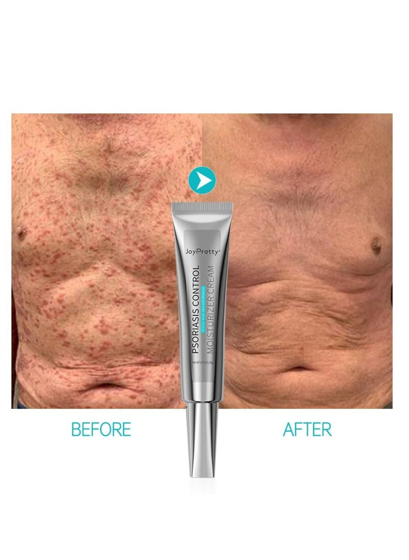 JoyPretty - Psoriasis Relief Cream Anti Bacterial Control Moisturizer Cream - Control & Reduce Scaly Skin and Redness - Cream With Natural Herbal Extracts For Men and Women 20g - Image 1