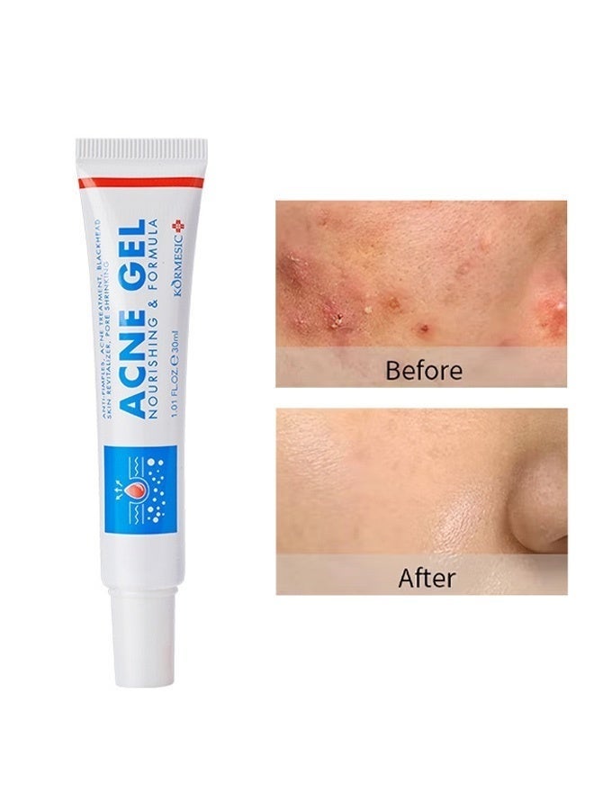 Kormesic Acne Gel 30ml Acne Spot Treatment gel Pimple Cream for Acne Prone Skin Care for All Skin Types - Image 1