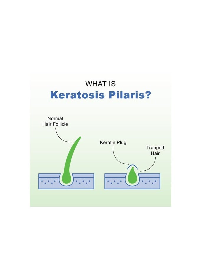 KP Elements KP Elements Keratosis Pilaris Lotion (4 fl oz) - Natural Keratosis Pilaris Treatment, Moisturizing & Exfoliating AHA Lotion for KP, Vegan, Made in USA  - Image 5