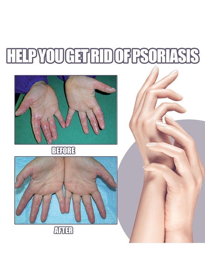 EELHOE Eczema and Psoriasis  Atomizing Spray 30ml, Hand and Foot Moss Skin Repair, Relieve Itching, Skin care and Jiejia spray, Antibacterialnot Irritating Safety - Image 5