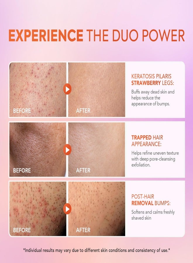 فيجوريتي مجموعة مقشر الجسم KP Bump Eraser ولوشن التقرن الشعري مع 10% من أحماض ألفا هيدروكسي وبيتا هيدروكسي - علاج سيقان الفراولة للنساء والرجال - يقشر ويرطب بعمق لبشرة أكثر نعومة وصحة - Image 3