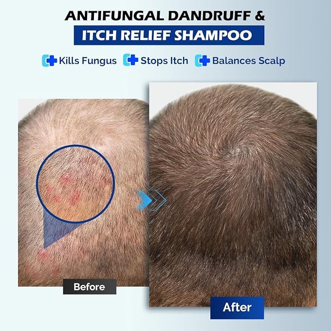 STRBOXONG Antifungal Shampoo for Seborrheic Dermatitis, Folliculitis Fresh - Image 2