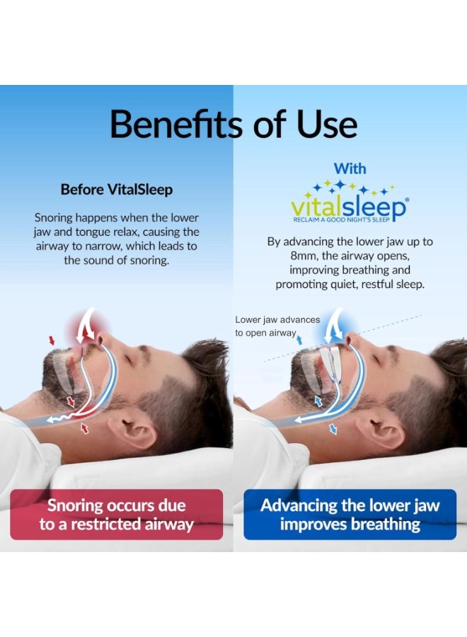 Arabest Anti-snoring Device Mouthpiece, Upgraded Adjustable Mouth Type Silicone Anti-snoring Device, Help Sleep at Night, Prevent Snoring and Snoring, Anti-grinding Braces Snoring Device (Standard Size)  - Image 4
