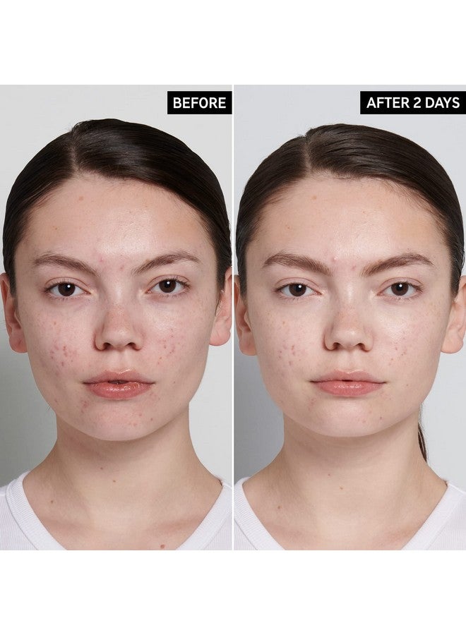 The INKEY List Succinic Acid Acne Treatment Reduce Blemishes And Clear Clogged Pores 1% Salicylic Acid .50 Fl Oz - Image 3