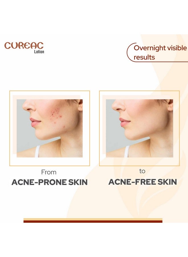 Salve Acne Drying Lotion For Overnight Results For Teens & Adults Fights Pimpleszits & Blemishes70 Ml (Pack Of 1) - Image 5