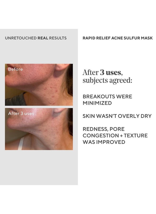 Murad - Rapid Relief Acne Sulfur Mask - Acne Control Clay Face Mask With Salicylic Acid - 2.5 Fl Oz - Image 1