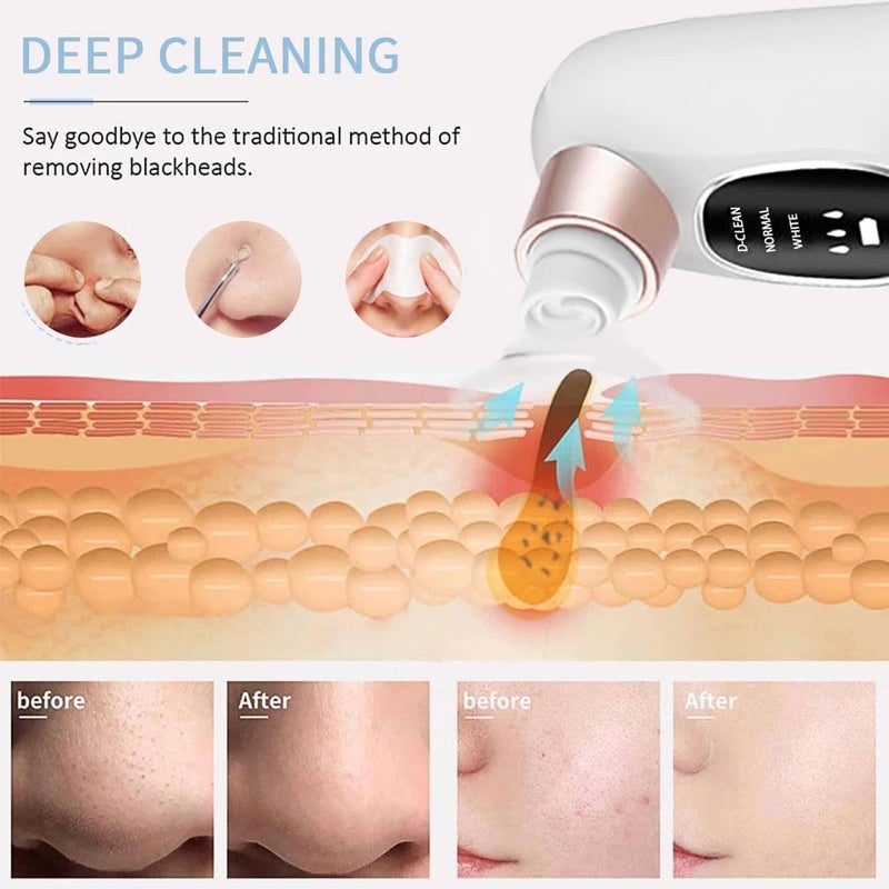 ADAK Electric Blackhead Remover Pore Vacuum Cleaner, Small Bubble Water Cycle Suction Facial Device for Acne, Pimple & Comedo Removal, Deep Pore Cleansing Beauty Tool (L) - Image 2
