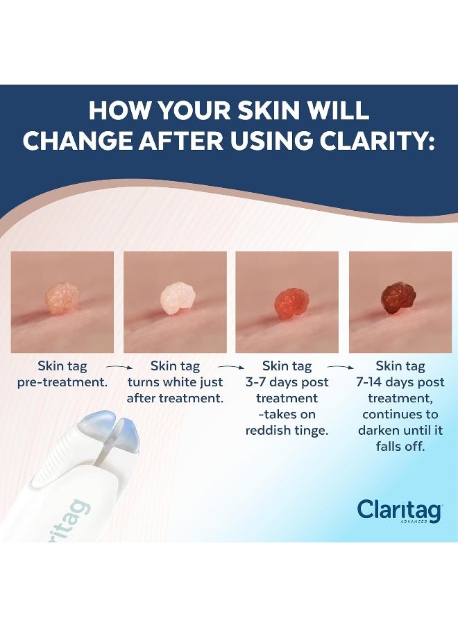 CLARITAG Advanced Skin Tag Remover - Fda-Cleared Device - Only For Skin Tag Removal - Works In 7-14 Days - Up To 10 Treatment Cycles - Cryogenic Freeze-Off Kit  - Image 4