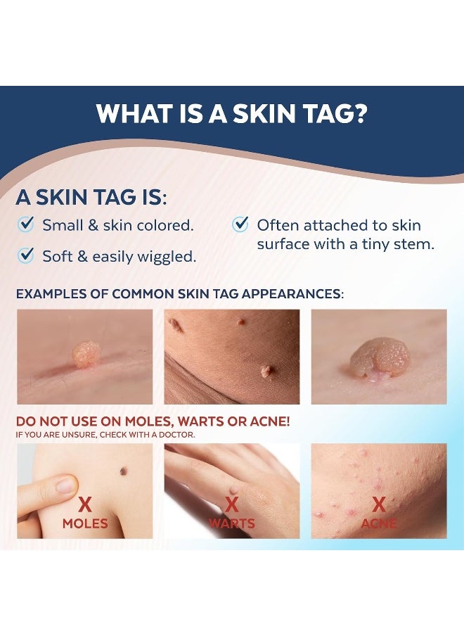CLARITAG Advanced Skin Tag Remover - Fda-Cleared Device - Only For Skin Tag Removal - Works In 7-14 Days - Up To 10 Treatment Cycles - Cryogenic Freeze-Off Kit  - Image 3
