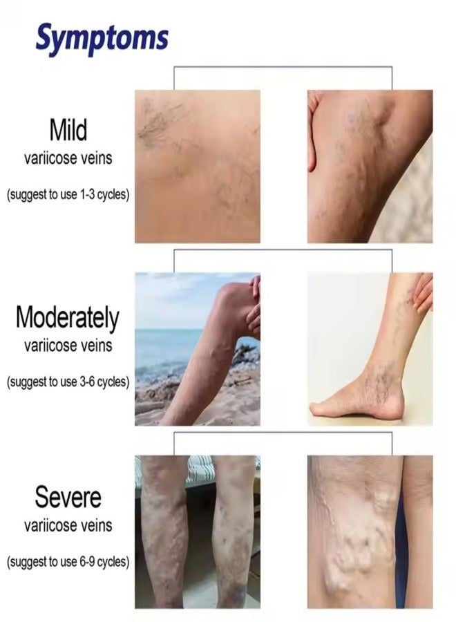 OUHOE OUHOE 30ml Varicose Vein Spray Safe Non-toxic Relieve Swelling Pain Improve Blood Circulation Tighten Skin Relax Muscles  - Image 2