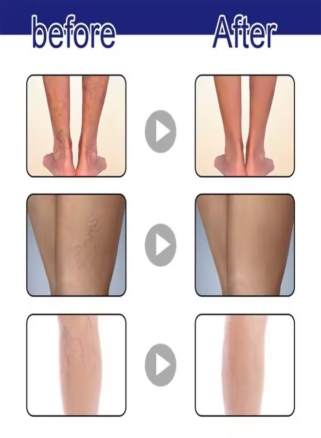 OUHOE OUHOE 30ml Varicose Vein Spray Safe Non-toxic Relieve Swelling Pain Improve Blood Circulation Tighten Skin Relax Muscles  - Image 3