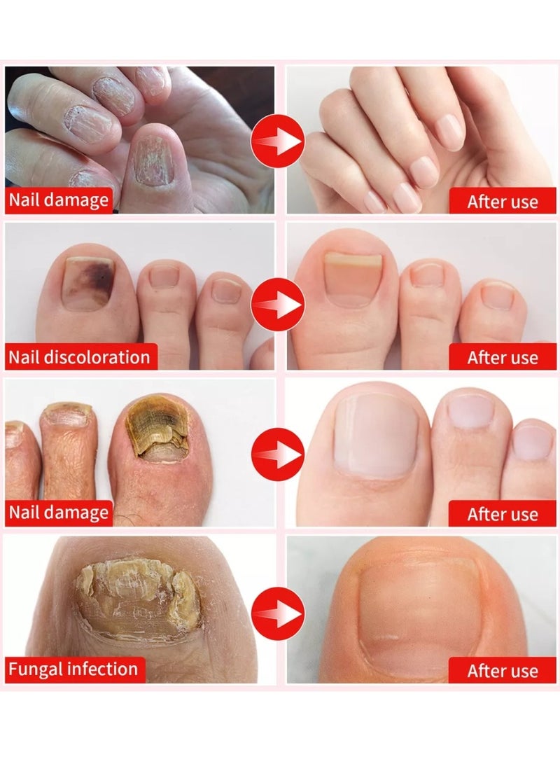 DERMFREE Fungi Nail Triple Action Formula Treatment Liquid Toenail and Fingernails Fungus Removal Serum Stop Itching Burning and Athletes Foot Treatment Serum Restore Healthy Nails Fungal Nail Liquid 15ml - Image 4