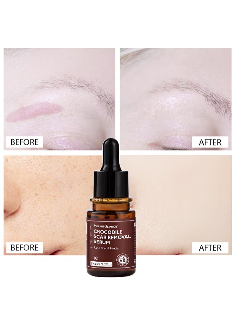 Vibrant Glamour Crocodile Scar Removal Serum Crocodile Scar Removal Serum  Pigmented Acne Treatment Stretch Mark Removal (30ml) - Image 2