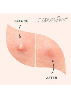 CARVENCHY Salicylic Acid Hydrocolloid Acne Patch Miracle Patch, Invisible Spot Cover, Ideal For On The Surface Spots 96PCS  - Image 4