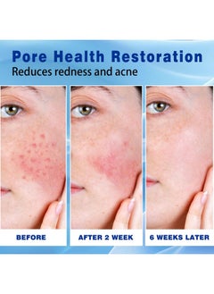 Sefralls Sefralls 10% Azelaic Acid Acne Cream, Premium Azelaic Acid Facial Cream - Redness Relief For Face, Redness Reducing Skin Care, Prevents Acne Breakouts, Ease Pimple Clarify Skin Soothe Irritation,1 Oz  - Image 3