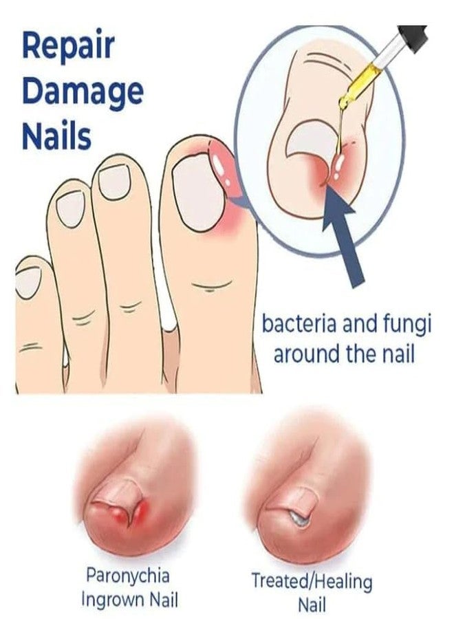 SYLVERA Anti Paronychia Relief Oil 10ml | Natural Nail Infection Treatment Oil | Pain Relief & Disinfection for Swollen Skin, Ingrown Nails & Nail Inflammation | Anti-Fungal Nail Care Oil (1, Milligrams) - Image 3