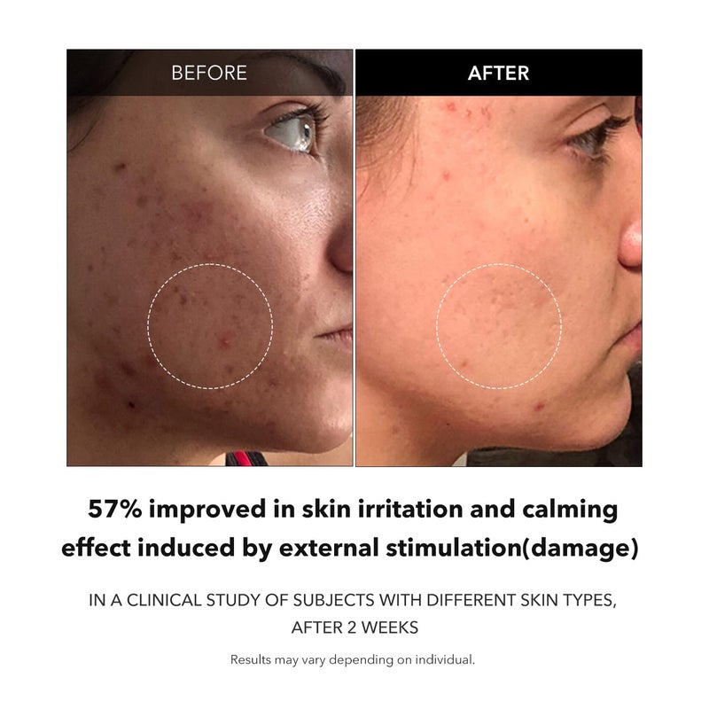 APRILSKIN Carrotene Clarifying Facial Serum | Vegan, Non-comedogenic | Blemish Clear, Dark Spot Corrector | Korea Skincare | Oily Skin, Sensitive Skin, Bumpy Skin | 1.25 fl.oz - Image 4