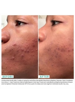 Urban Skin Rx Clear Complexion Acne Serum + Spot Treatment | Helps to Reduce + Prevent Breakouts, Improves the Look of Blemishes and Aging Skin with 5% Benzoyl Peroxide and 5% Glycolic Acid | 1 Fl Oz  - Image 5
