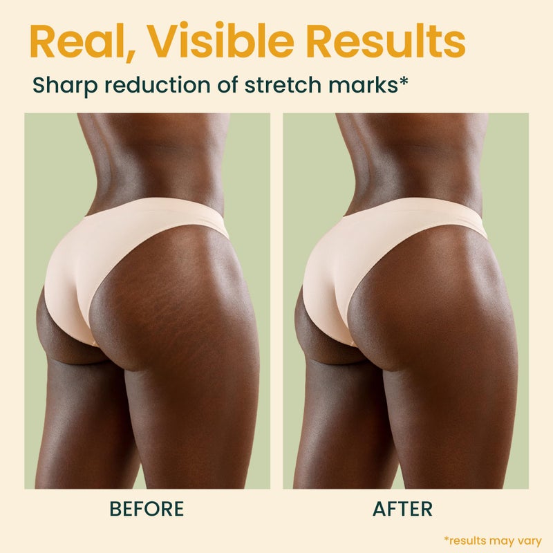 Honeyskin Bio Pure Skincare Oil for skin - Moisturizer for Dry Skin - Pregnancy Stretch Mark Prevention - Oil for Scars - Stretch Mark Treatment with Organic Sweet Almond Oil & Jojoba Oil for skin (8oz) - Image 5