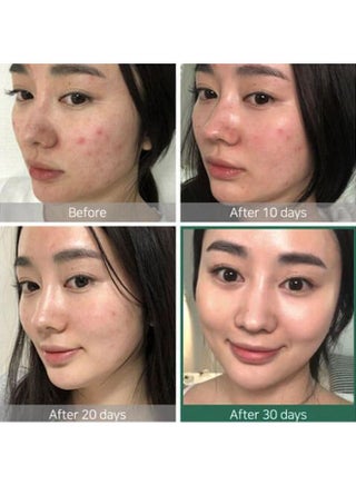 تونر معجزة يدوم 30 يومًا AHA-BHa-PHA 150 مل + كريم معجزة شفاف 60 جرامًا شفاف 60جرام - view 4