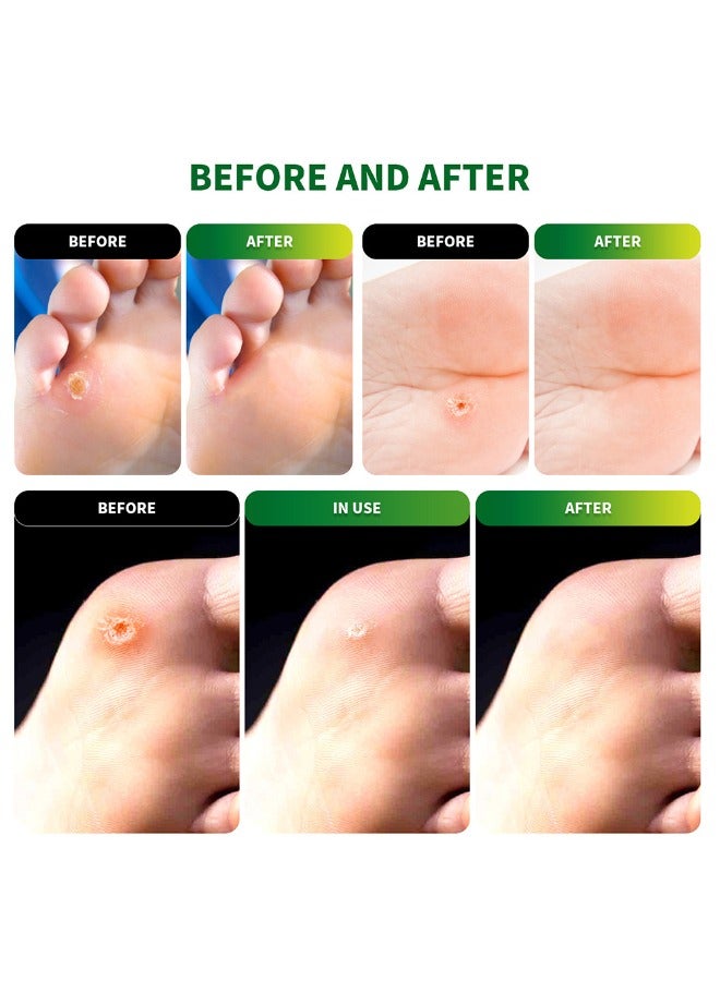 Sumifun 54 Pieces Of Foot Corn Removal Cream, Natural Ing Pain Caused By Calluses, Corns, Blisters, Heel Friction  - Image 5