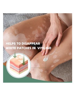 Sumifun Vitiligo Relief Cream 20G, Treatment for Skin Vitiligo Ointment, Fade White Spot and Improve Skin Pigmentation Cream, Vitiligo Cream for Skin Healthy Care  - Image 3