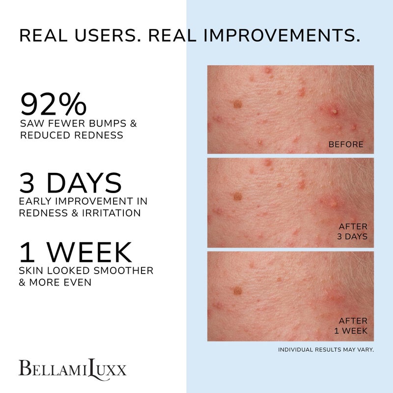 BellamiLuxx Folliculitis Acne Lotion for Body: Helps Reduce Itch, Redness, Body Acne, Bumps & Uneven Texture with Salicylic & Glycolic Acid + Botanicals - Gentle Care for Folliculitis-Prone Skin - Image 2