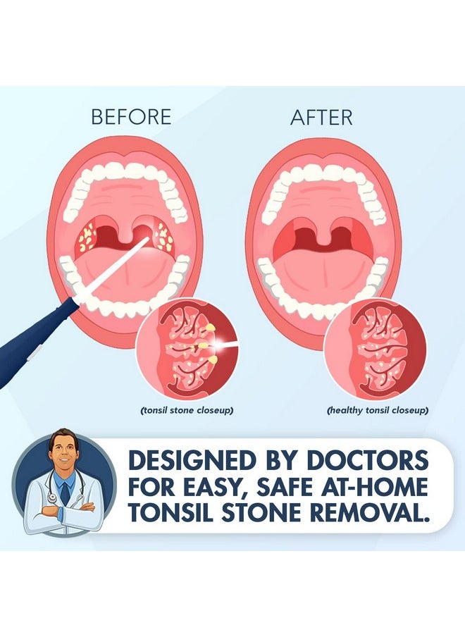 Dr. Frederick’S Original Easy Tonsil Stone Remover Kit Fast Painless Tonsillolith Removal Tool Fight Bad Breath Pick And Oral Irrigator 8 Pieces - pzsku/ZD808C1040AF27E0D8641Z/45/_/1719337908/e798bda1-4863-47b2-bc0b-406219f2198f