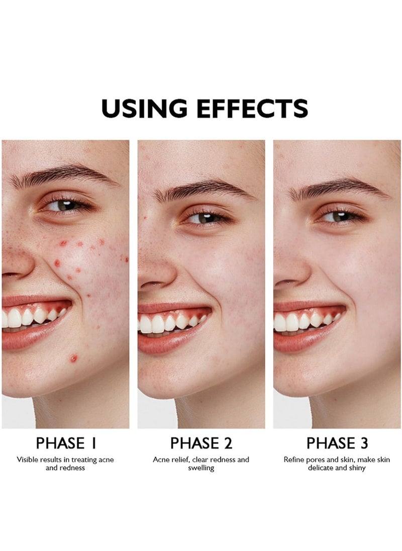 lakerain - Azelaic Acid Serum 10% with Licorice Root (30ml), Lightweight Formula for Uneven Skin Tone, Dark Spots, and Acne Marks – Refines Skin Texture, Reduces Pimple Breakouts, Blackheads, Pigmentation - Image 1