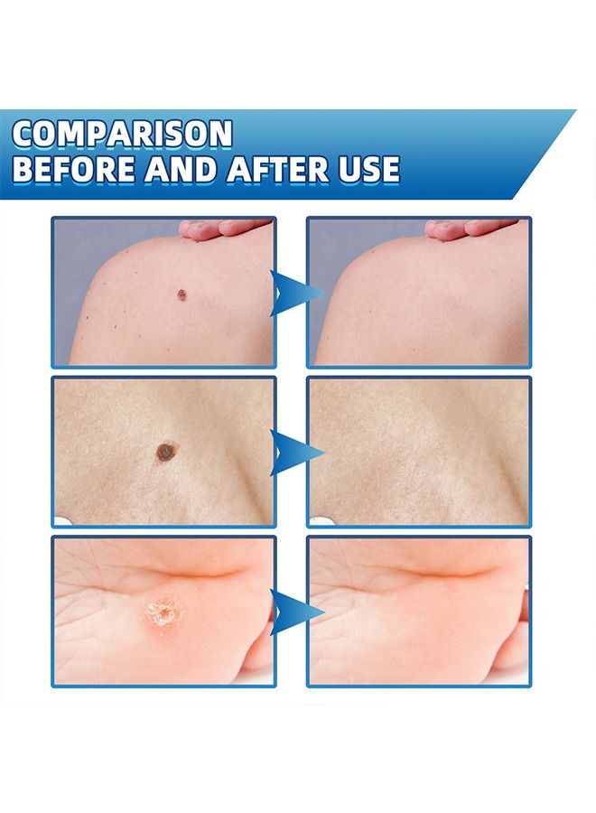 Jaysuing 20g Skin Tag Wart Removal Ointment - Plantar Warts  - Image 5