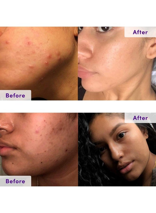 NXN - NxN Acne Treatment Kit 4-Step Clear Skin System with Salicylic Acid, Probiotics, Sulfer & Natural Retinols, Control Blemishes & Breakouts, Face Care Solution Set for All Skin Types Including Sensitive - Image 1